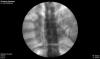 Chest under fluoroscopy